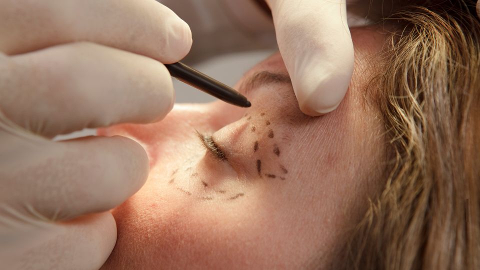 Are Plastic Surgery Procedures Permanent